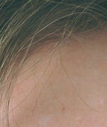 Laser treatments for Sebaceous Hyperplasia after 89121