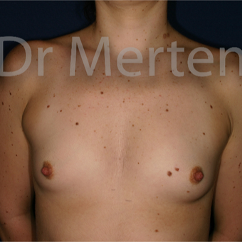 18-24 year old woman treated with Breast Augmentation before 3552658