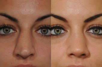 21 year old female underwent rhinoplasty 772880