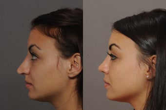 21 year old female underwent rhinoplasty 772880