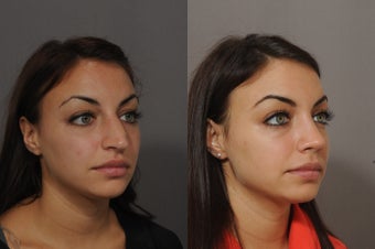 21 year old female underwent rhinoplasty after 772880
