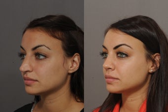 21 year old female underwent rhinoplasty before 772880