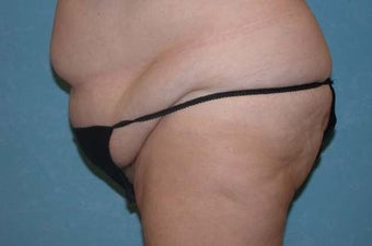 Circumferential Body Lift before 857222