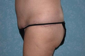 Circumferential Body Lift after 857222