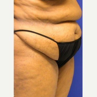 55-64 year old woman treated with Tummy Tuck before 1863432