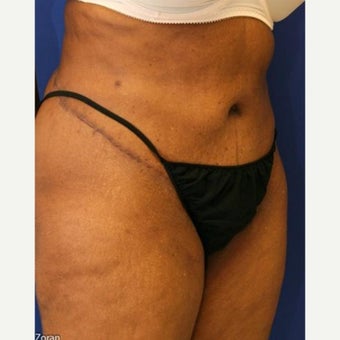 55-64 year old woman treated with Tummy Tuck after 1863432