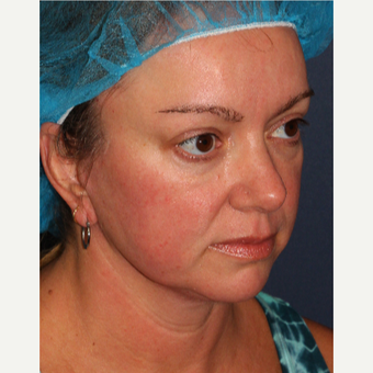 35-44 year Old Woman Treated for Facial Redness with IPL after 3346040