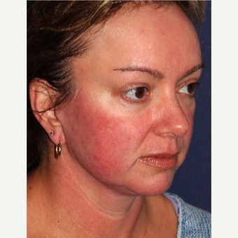 35-44 year Old Woman Treated for Facial Redness with IPL before 3346040