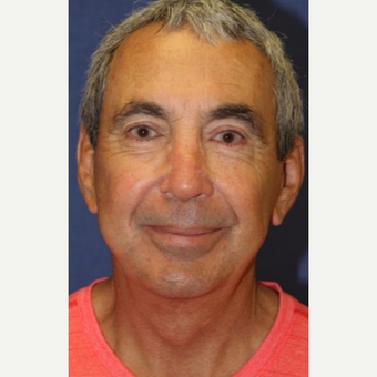 67 year old man with a Facelift after 3104434
