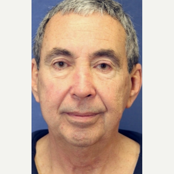 67 year old man with a Facelift before 3104434
