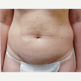 35-44 year old woman treated with Tummy Tuck before 3458258