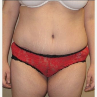 35-44 year old woman treated with Tummy Tuck after 1661548