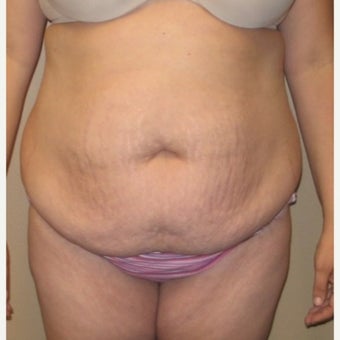 35-44 year old woman treated with Tummy Tuck before 1661548