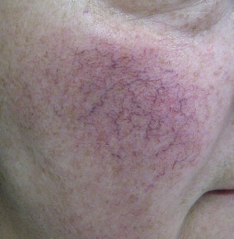 64 year old male with facial veins / telangiectasia before 694743