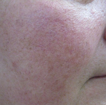 64 year old male with facial veins / telangiectasia after 694743