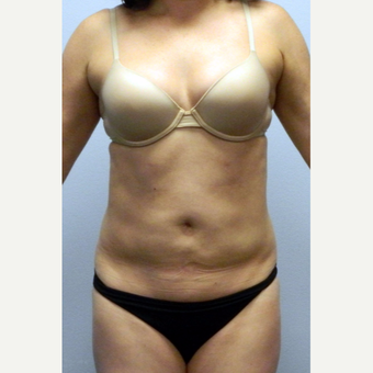35-44 year old woman treated with Liposuction of the abdomen and flanks after 3135598