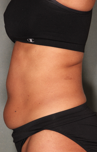 SmartLipo™ before 529473