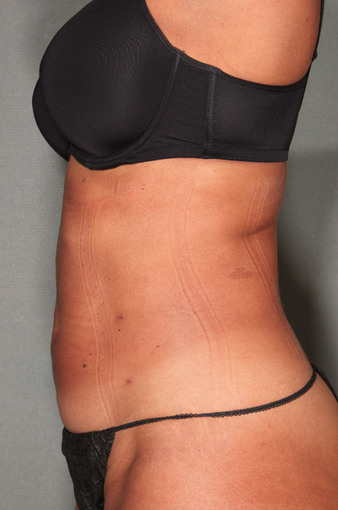 SmartLipo™ after 529473
