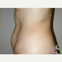 40 year old woman treated with Tummy Tuck before 3484917