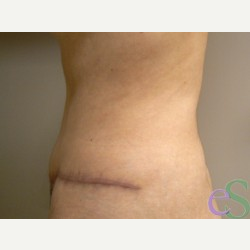 40 year old woman treated with Tummy Tuck after 3484917