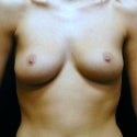 Breast Augmentation before 976013