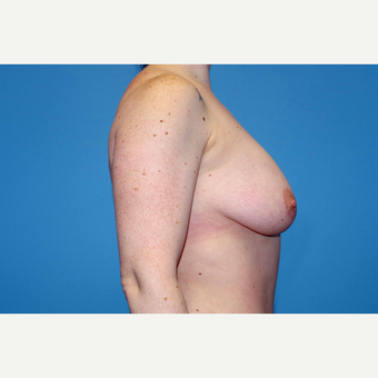 25-34 year old woman treated with Breast Augmentation before 3280666
