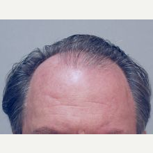 Hair Transplant before 3241360