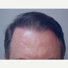Hair Transplant after 3241360