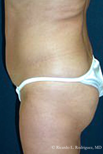 Brazilian Butt Lift before 98185