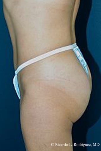 Brazilian Butt Lift after 98185