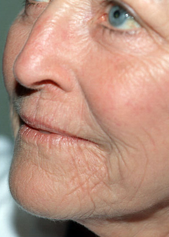 Laser Resurfacing before 1072048