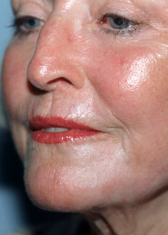Laser Resurfacing after 1072048