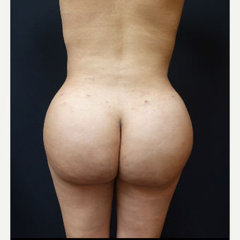 25-34 year old woman treated with Liposculpture after 3286447