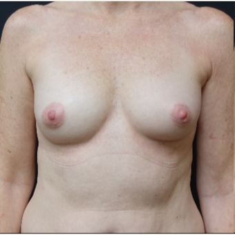 35-44 year old woman treated with Natrelle Breast Implants before 3280325