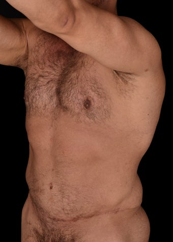 35-44 year old man treated with Liposuction Revision before 3220606