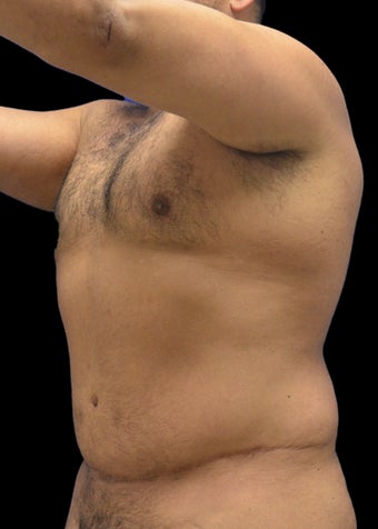 35-44 year old man treated with Liposuction Revision after 3220606
