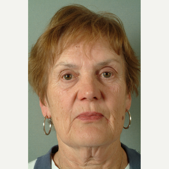 55-64 year old woman treated with Facelift before 3266948