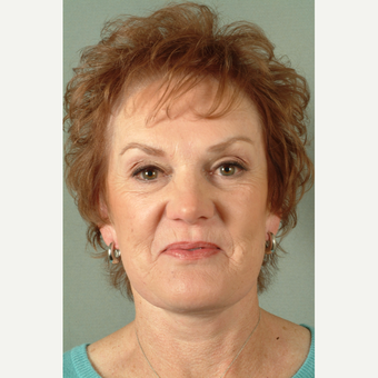 55-64 year old woman treated with Facelift after 3266948