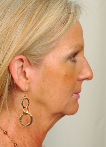 55 year old woman treated with Rhinoplasty before 2882976