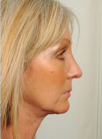 55 year old woman treated with Rhinoplasty after 2882976