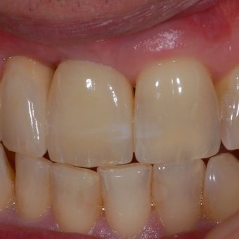 35-44 year old man treated with Dental Implants after 1754585