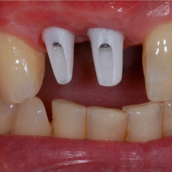 35-44 year old man treated with Dental Implants before 1754585