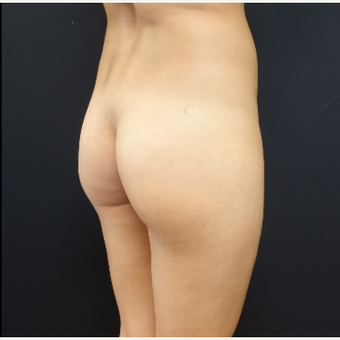 25-34 year old woman treated with 548cc Silicone Butt Implants before 3033261
