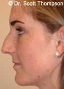 16 Year Old Female with Rhinoplasty before 825392