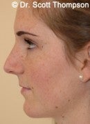 16 Year Old Female with Rhinoplasty after 825392