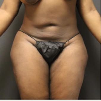 35-44 year old woman treated with Smart Lipo before 3286848