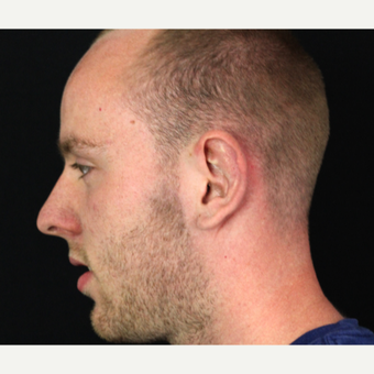 18-24 year old man treated with Ear Surgery before 3020605