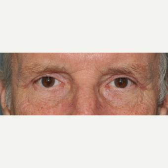 65-74 year old man treated with Eyelid Surgery after 3508726