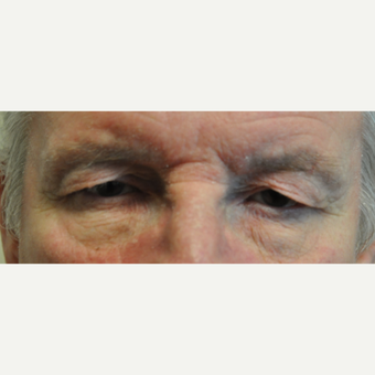 65-74 year old man treated with Eyelid Surgery before 3508726