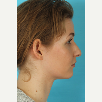 25-34 year old woman treated with Rhinoplasty before 3629399